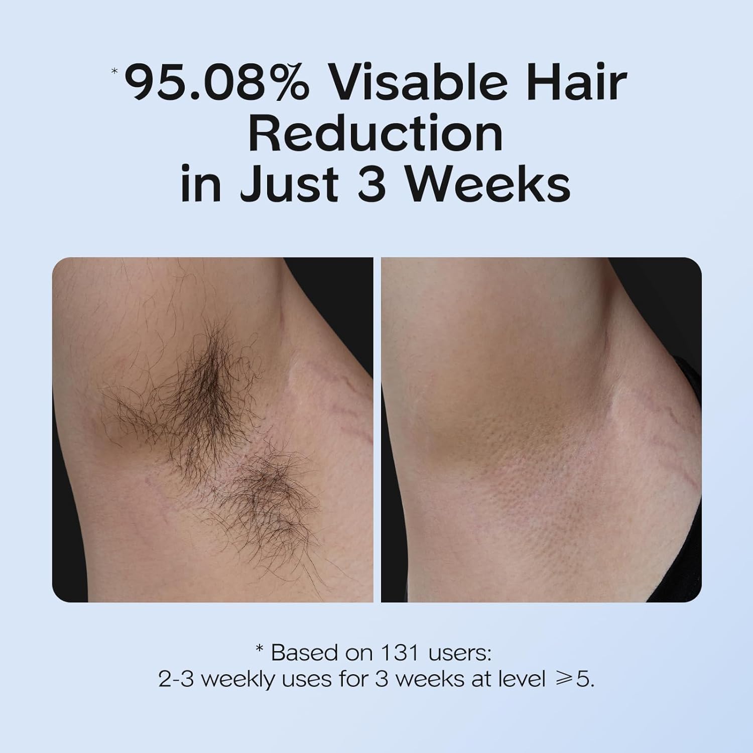 SmoothSkin Laser Hair Remover